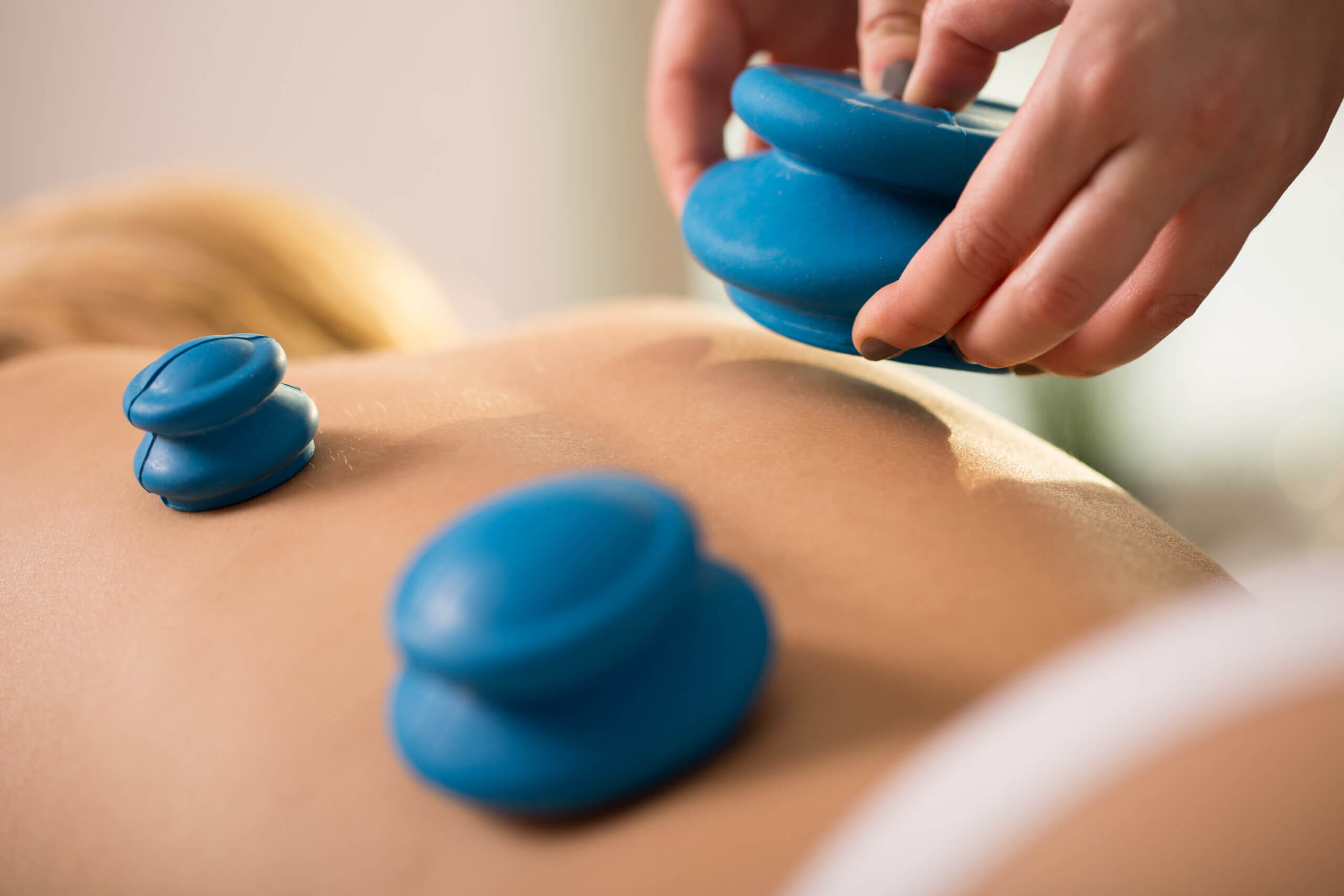 Cupping Therapy Sammamish Redmond